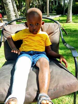 A young boy sitting in a chair with a cast on his leg.